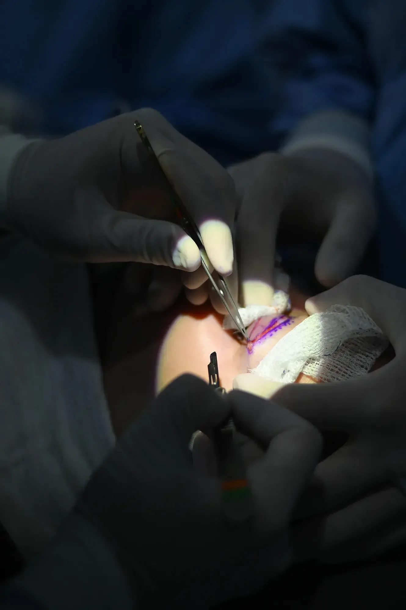 Blefaroplastia