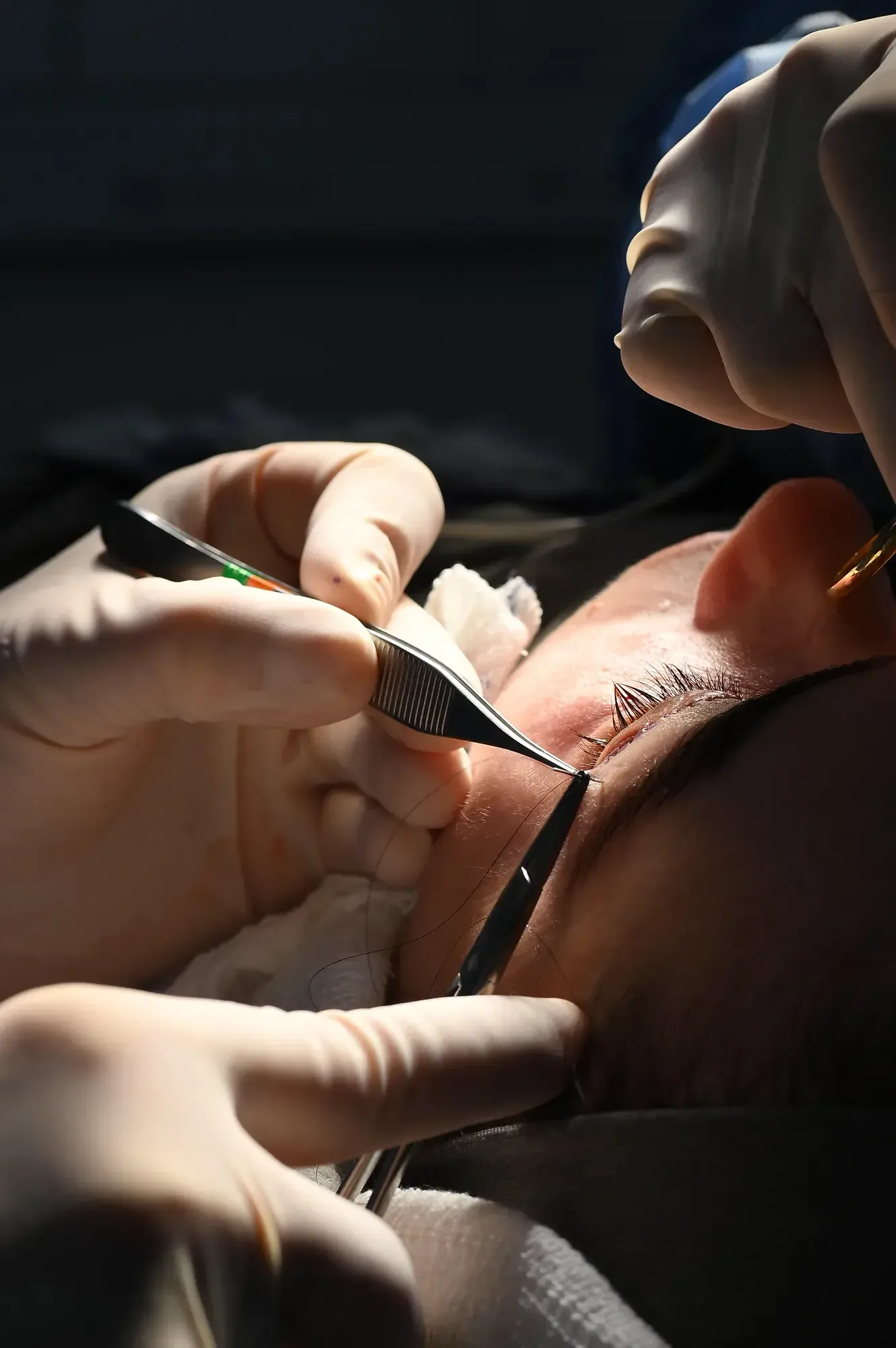 Blefaroplastia — sutura